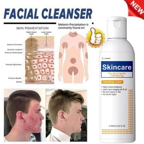 Skincate For Acne - Sports Cleansing Lotion 100ML (Pack of 2)